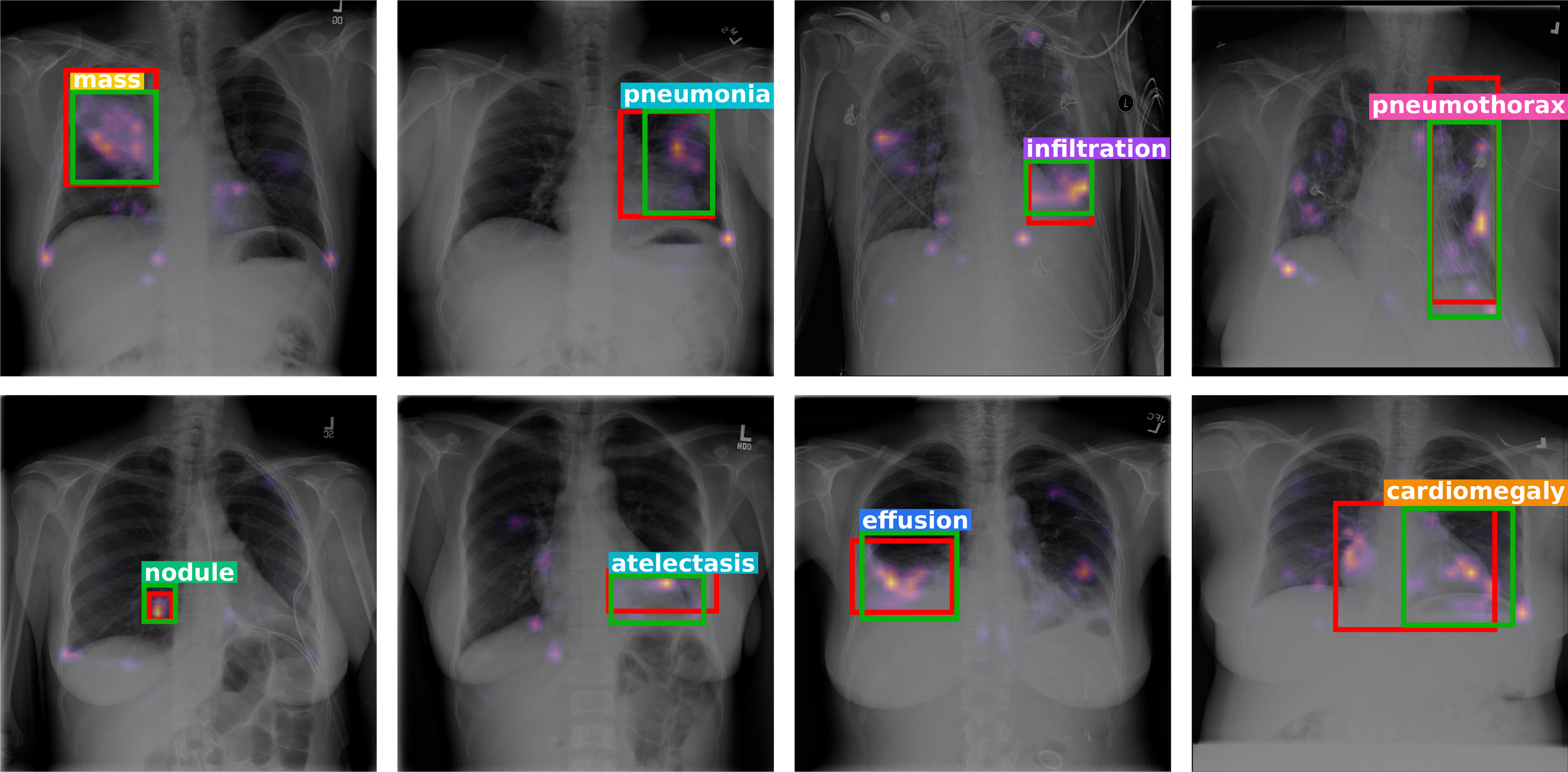Class-wise predictions of ASH-MIL with evidence maps on NIH ChestX-ray8