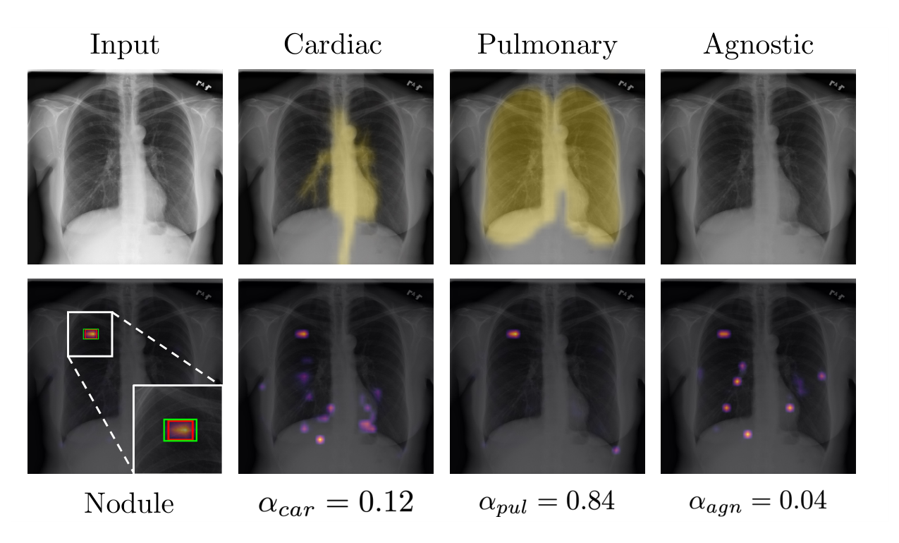 Qualitative results on CXR8
